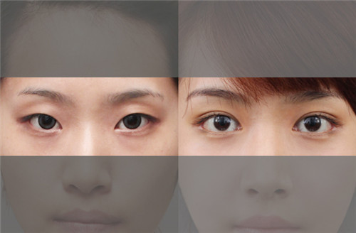 韩国原辰整形外科眼部案例