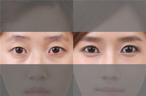 韩国眼部整形手术价格多少钱？