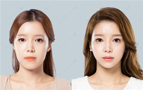韩国ID轮廓手术案例