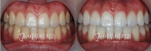 韩国erumi牙科医院牙齿美白案例对比图