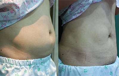 韩国德克莱斯（classic）整形医院腰腹吸脂案例对比图