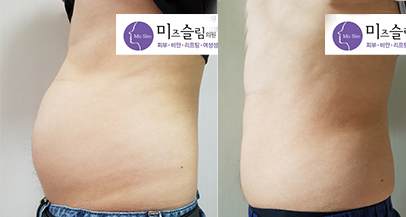 韩国美姿（mizslim）吸脂医院腹部吸脂案例对比图