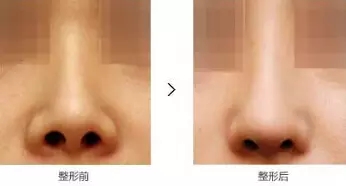 韩国隆鼻修复