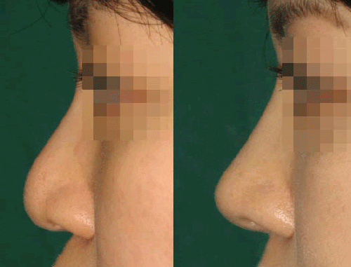 韩国CNM（COANMI）整形外科医院隆鼻案例对比图