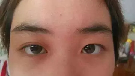 双眼皮一单一双，去韩国只做一只眼睛可以吗？