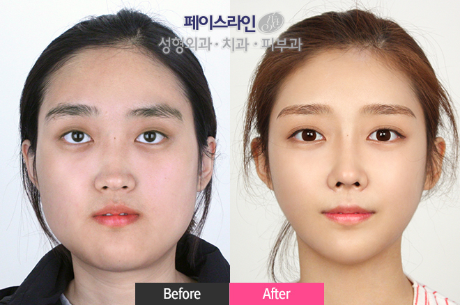 韩国faceline轮廓手术对比