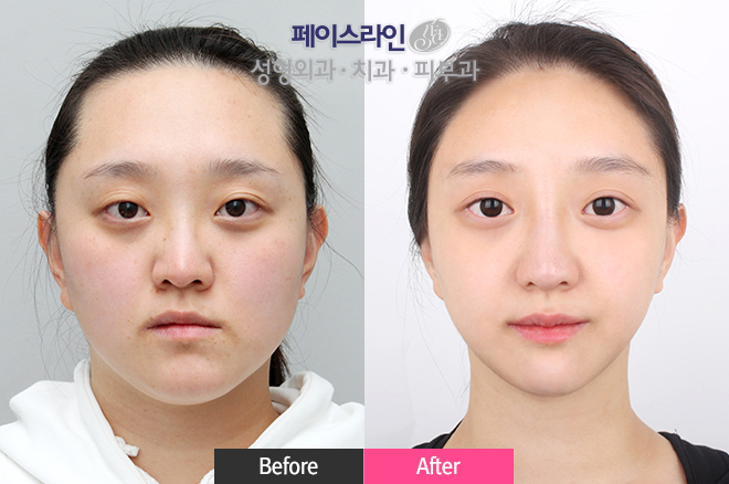 韩国faceline轮廓手术对比