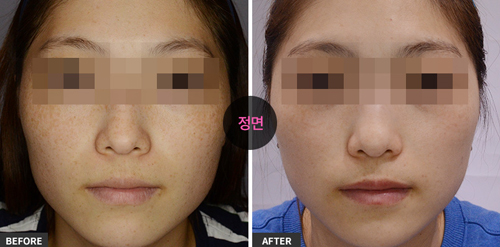 韩国Clean N 皮肤科医院祛斑案例对比图