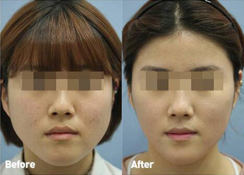 韩国Toxnfill整形外科瘦脸针瘦脸案例对比图