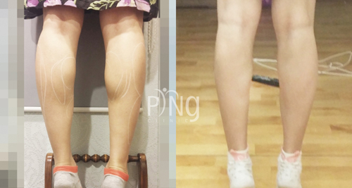 韩国PING皮肤科医院注射瘦脸针瘦小腿案例对比图