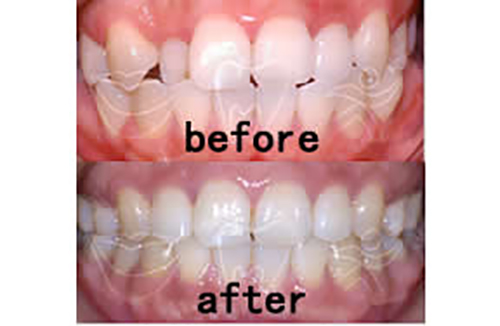 笑逐颜开牙科牙齿矫正案例对比图