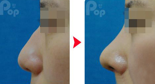 韩国POP整形外科驼峰鼻矫正案例对比图