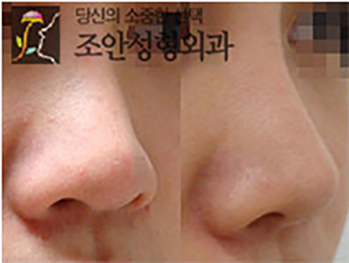 造颜整形外科鼻尖延长案例对比图
