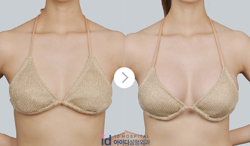 韩国假体隆胸手术