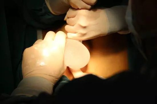韩国假体隆胸手术过程