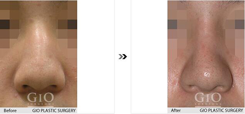 韩国GIO整形外科歪鼻矫正手术案例对比图