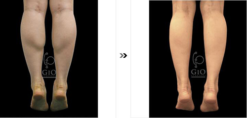 韩国GIO整形外科小腿整形案例对比图