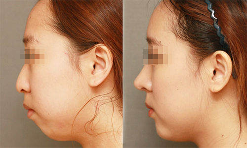 韩国D&A整形外科医院隆鼻案例对比图