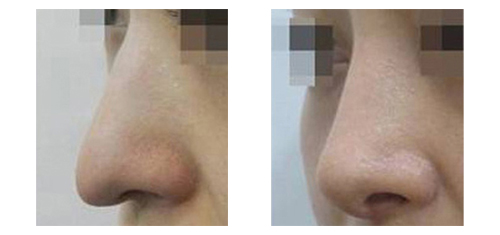 韩国SamSkin整形外科鹰钩鼻矫正手术案例对比图