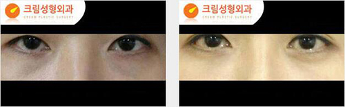 韩国Cream整形外科去眼袋日记对比图