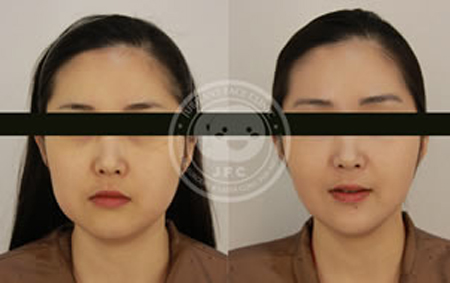 韩国姿飞抗老化医学美容中心面部轮廓案例对比图
