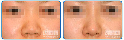 韩国一美知整形外科医院隆鼻案例对比图