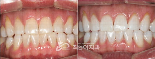 韩国CHOI&LEE牙科诊所牙齿美白案例对比图