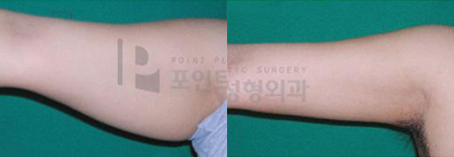 韩国POINT整形外科手臂吸脂案例对比图