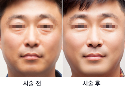 江南Theme皮肤科医院去眼袋案例对比图