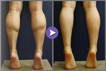 韩国Valinew整形外科瘦小腿案例对比图