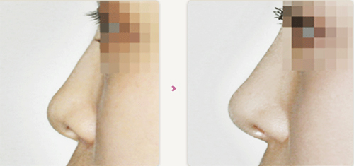 韩国GAAM整形外科隆鼻案例对比图