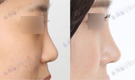 韩国哈娜儿整形外科隆鼻日记对比图