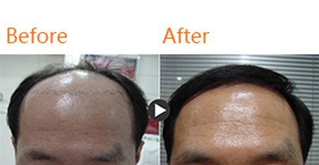 韩国HIGH MAN’S整形医院毛发移植案例对比图