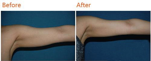 韩国Dr.Min’s整形外科手臂吸脂案例对比图