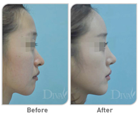 韩国DIVA整容外科医院隆鼻案例对比图