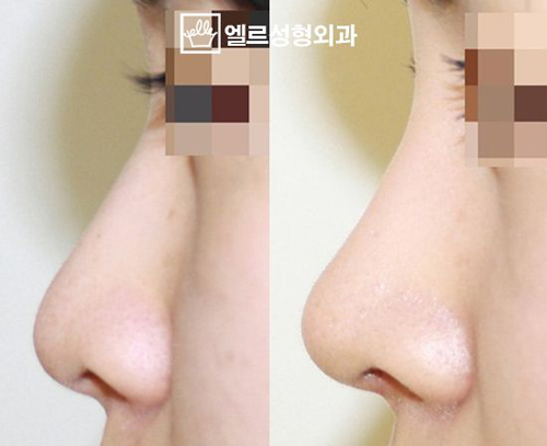 韩国Elle整形外科隆鼻案例对比图