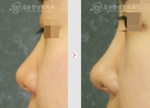 韩国KSJ整形外科隆鼻日记对比图