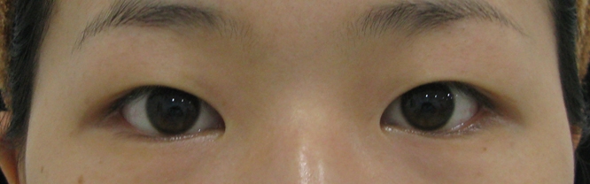 韩国BK外科肿眼泡做成双眼皮效果自然吗？