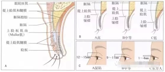 双眼皮眼部结构剖析图
