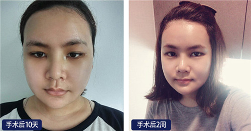 韩国faceline与丽珍医院的脸型手术怎么样？