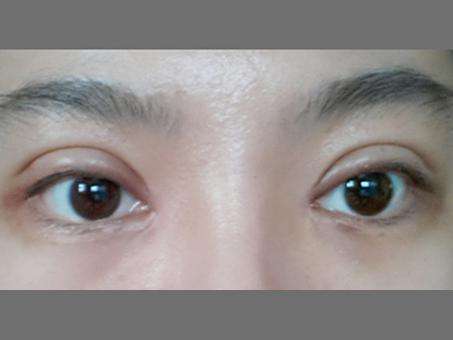 韩国ACE整形外科修复双眼皮疤痕怎么样？