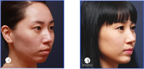 韩国NANO整形外科隆鼻对比图片