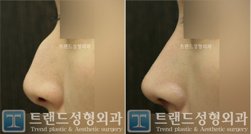 韩国trend驼峰鼻整形前后对比图片