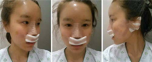 ID鼻子修复术后恢复图片