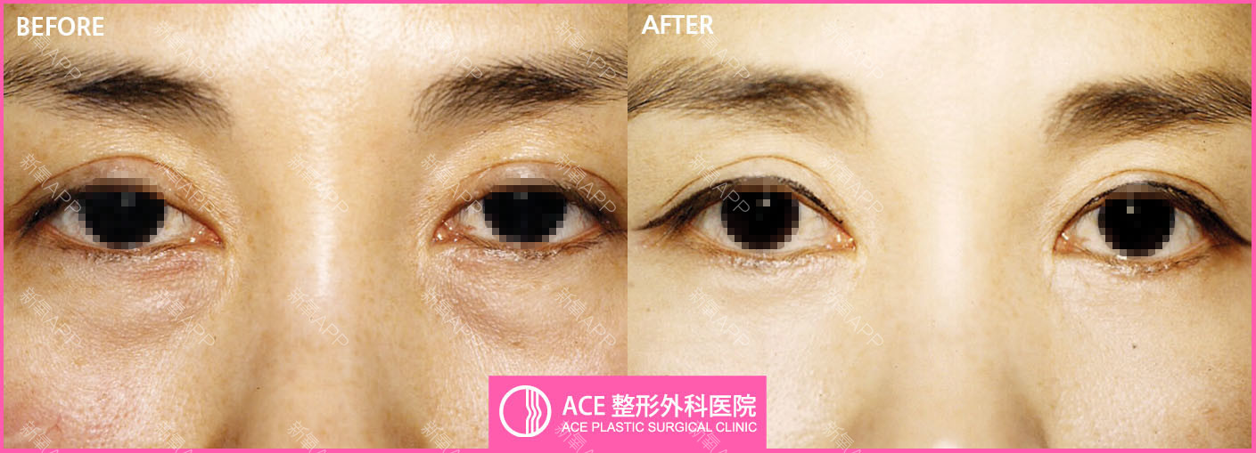 韩国ACE激光祛眼袋恢复图片
