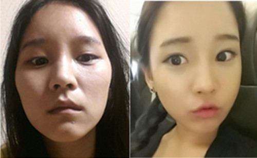 韩国爱我医院双眼皮恢复对比图片