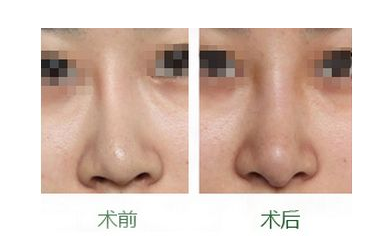 韩国face-line整形鼻修复前后对比图