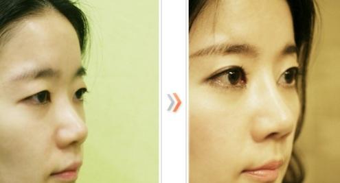 韩国眼部提肌矫正对比
