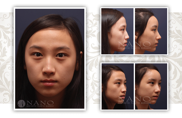 韩国nano鼻整形恢复图片