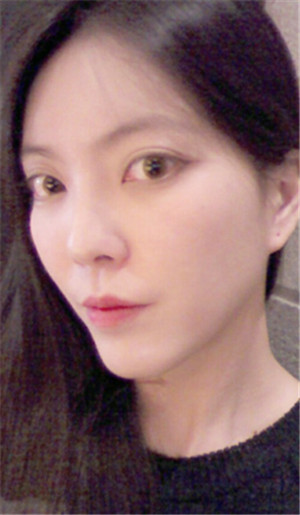 韩国TL隆鼻术前照片